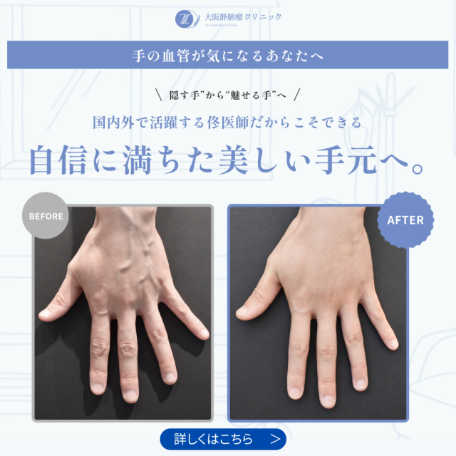 ハンドベインバナー