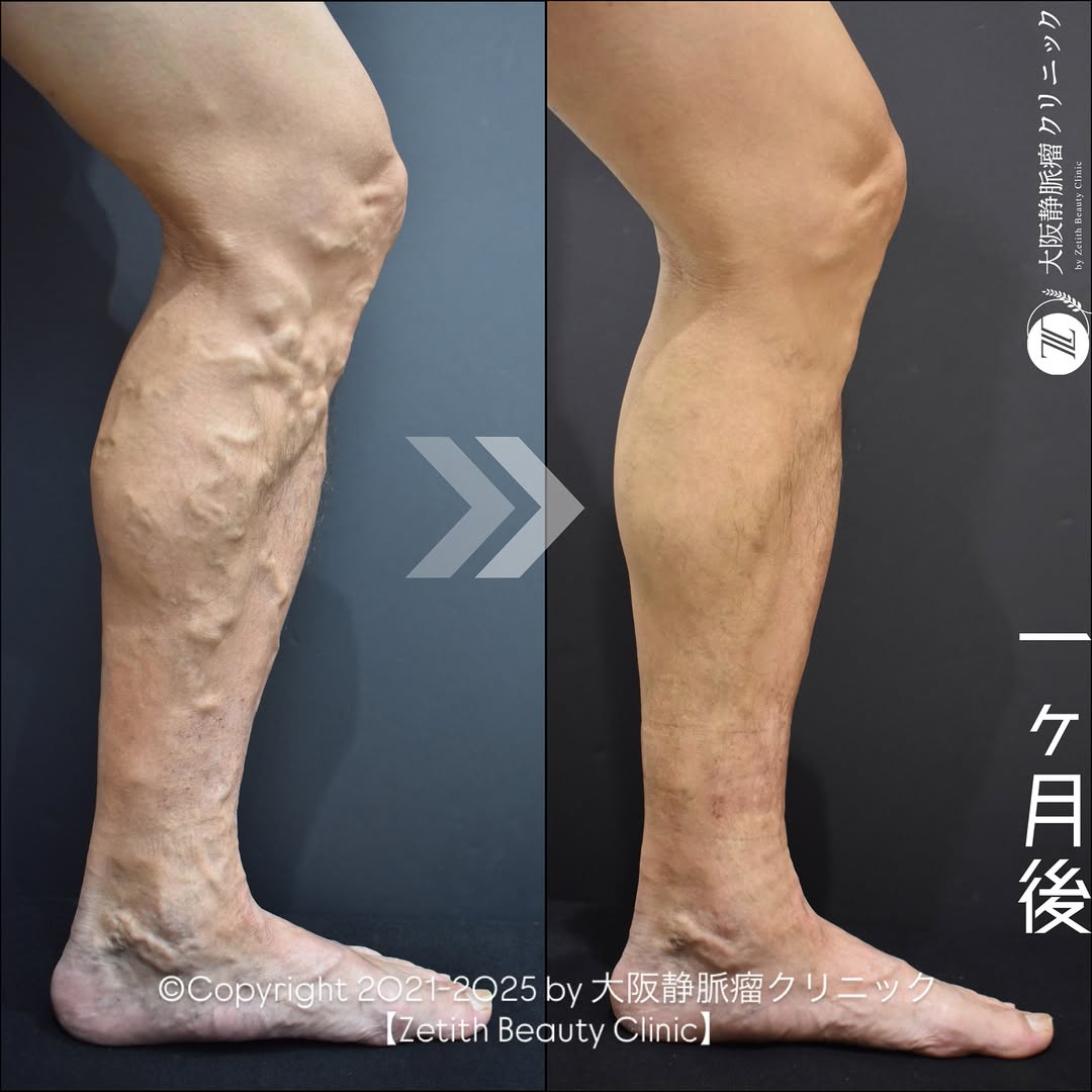 下肢静脈瘤