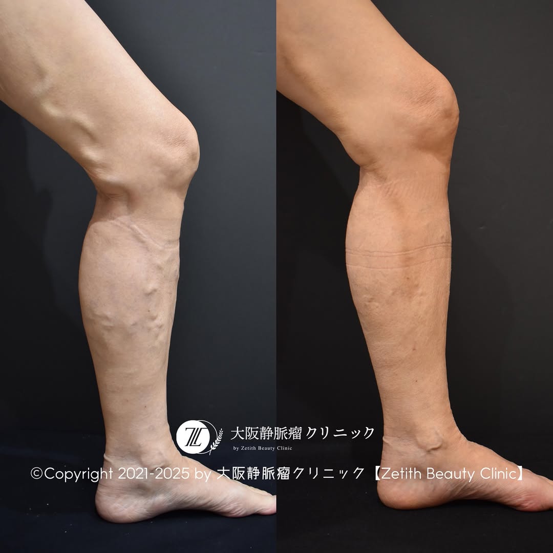 下肢静脈瘤