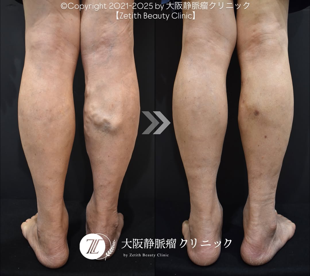 下肢静脈瘤