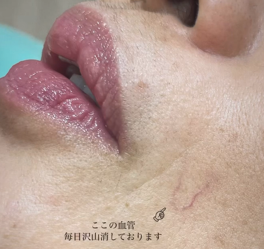 顔の毛細血管拡張症に対する効果的な治療法の選び方