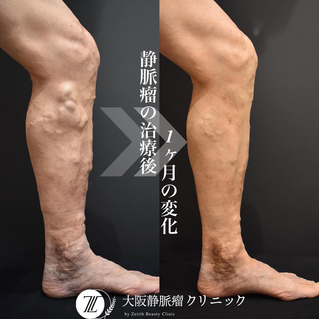 下肢静脈瘤手術のデメリットを徹底解説！後悔しないための全知識