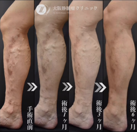下肢静脈瘤、何科を受診すべき？——血管外科の専門クリニック医師が教える“失敗しない”病院の選び方