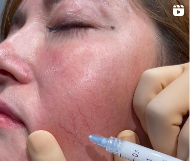 【顔の赤み、根本治療への道】原因から最新治療まで徹底解説｜大阪静脈瘤クリニック監修