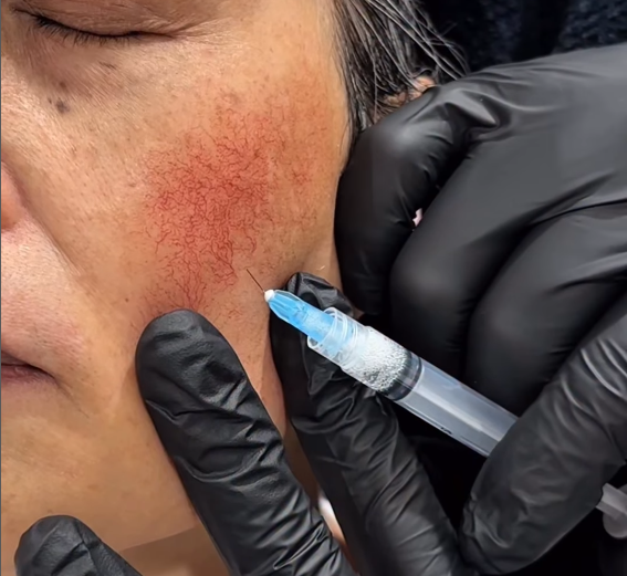 【血管外科専門の医師が教える】赤ら顔がレーザーで治らない本当の理由｜効果が出ない原因と“根本治療”