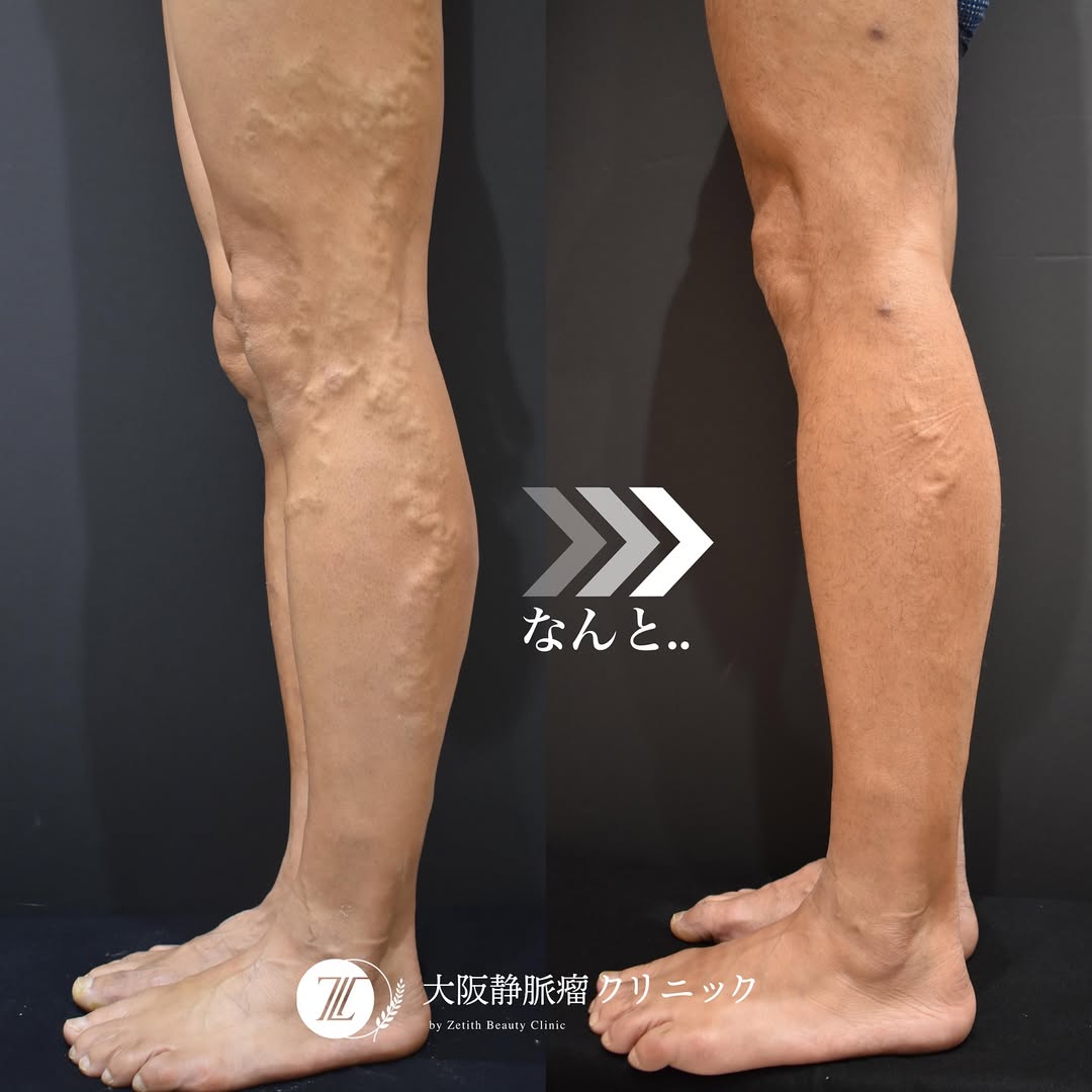 下肢静脈瘤は日帰りで治療できる？歩いて帰れるのか、血管外科専門の医師が解説