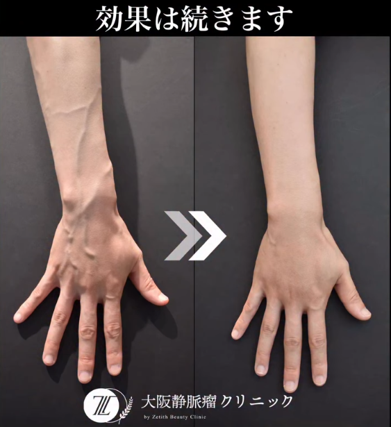 ハンドベイン治療の効果はどれくらい？手の血管は本当に目立たなくなるのか
